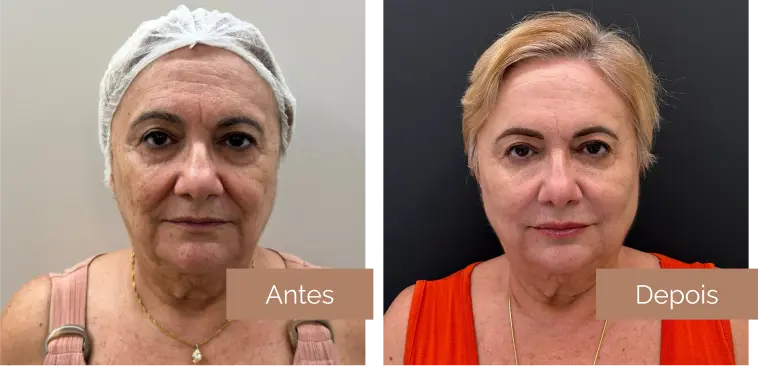 depois 1