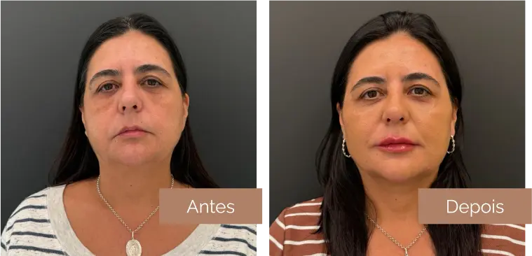 depois 4